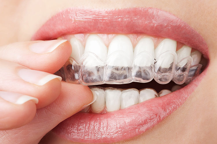 Clear Aligners: How They’re Changing the Future of Orthodontics