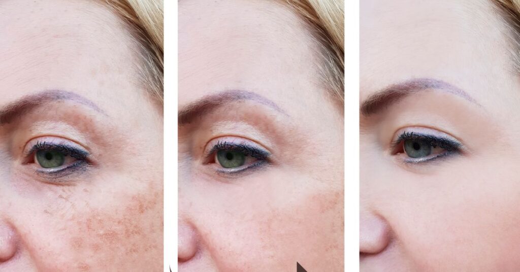 How To Maintain Your Results After Botox Treatments
