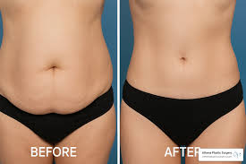 The Role of Liposuction in Body Contouring