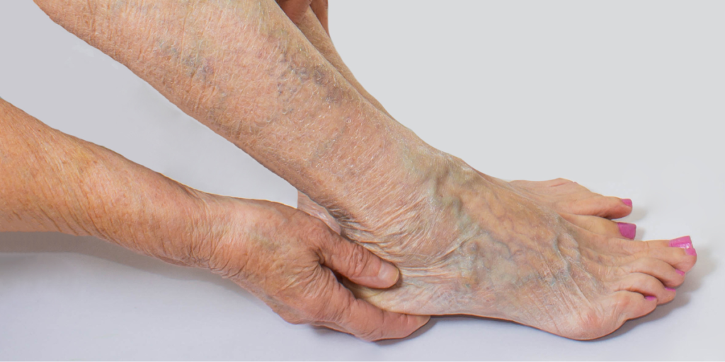 Understanding the Causes and Risk Factors of Varicose Veins