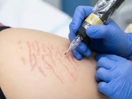 Common Myths About Tattoo Removal Debunked