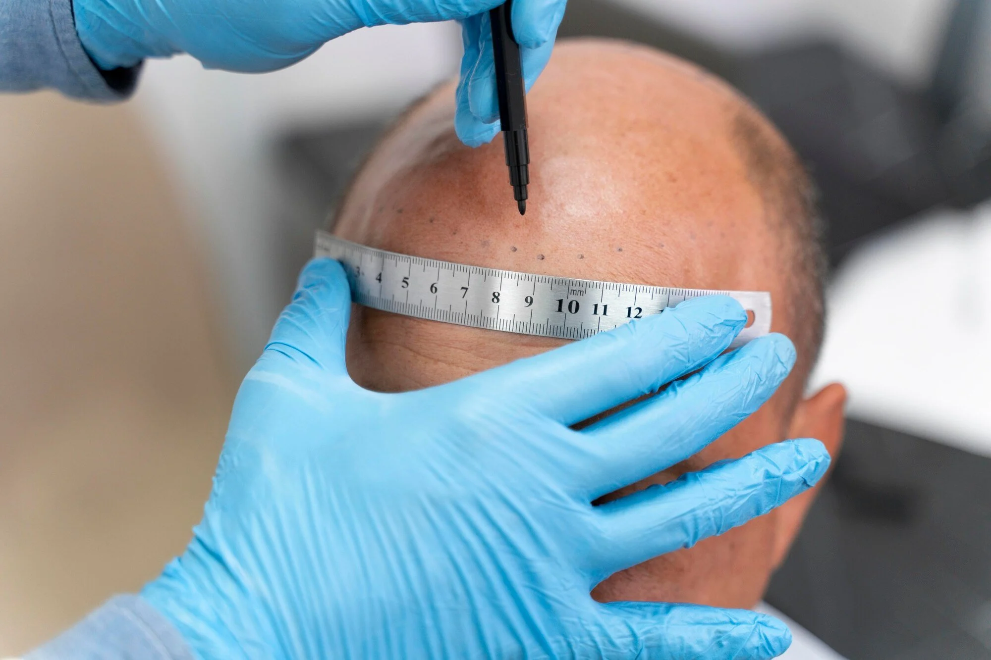 Surgical Vs. Non-Surgical Hair Transplant Methods