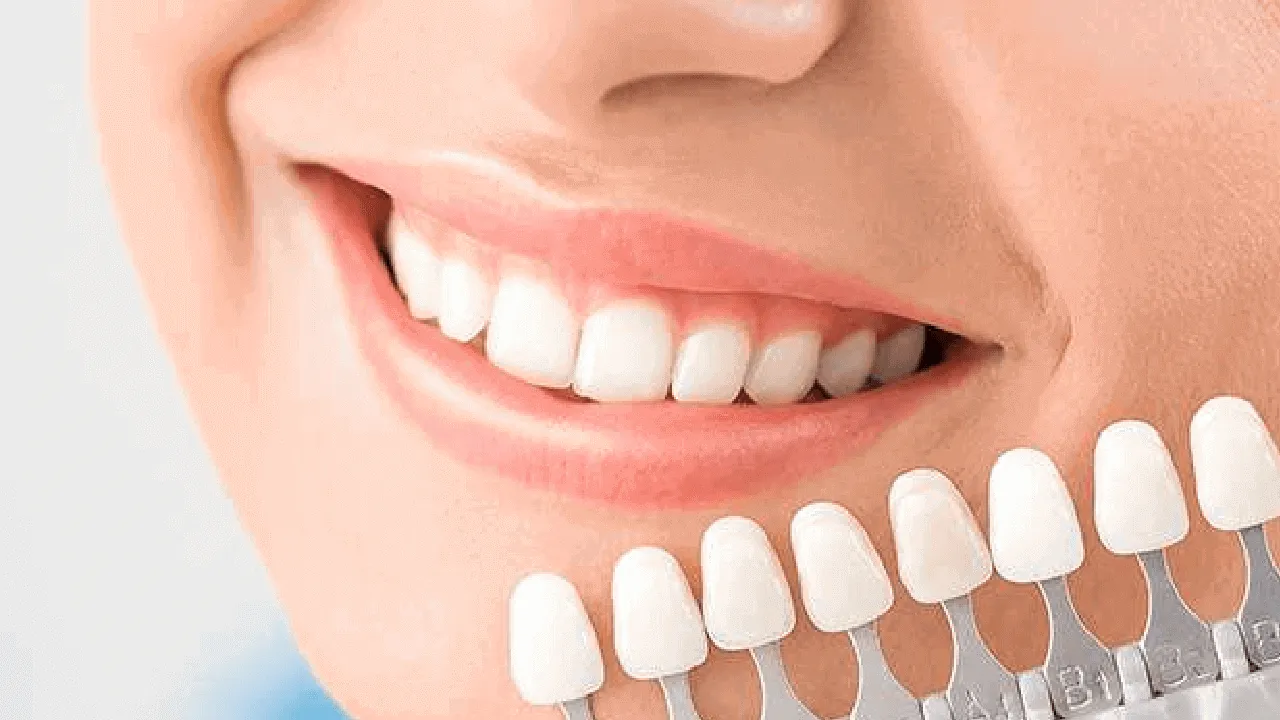 Choosing the Right Type of Veneers for Your Smile