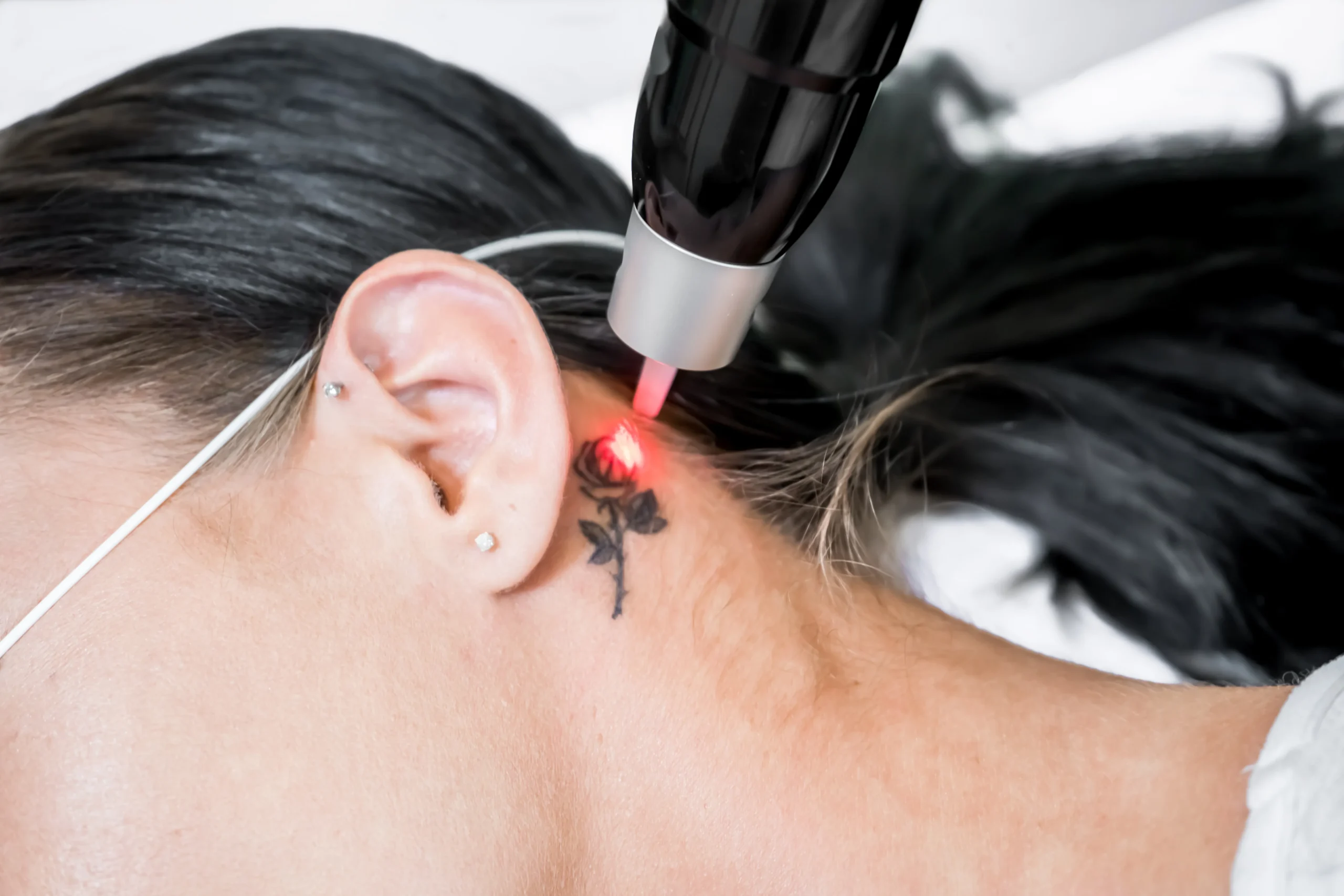 Helpful Things To Know About Tattoo Removal