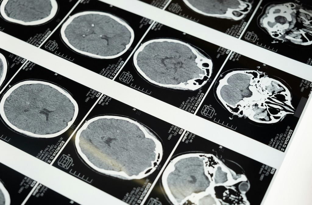 How Brain MRI Can Provide Insight Into Cognitive Disorders