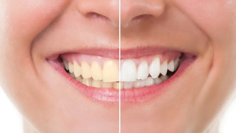 How to Prepare for Your First Teeth Whitening Appointment