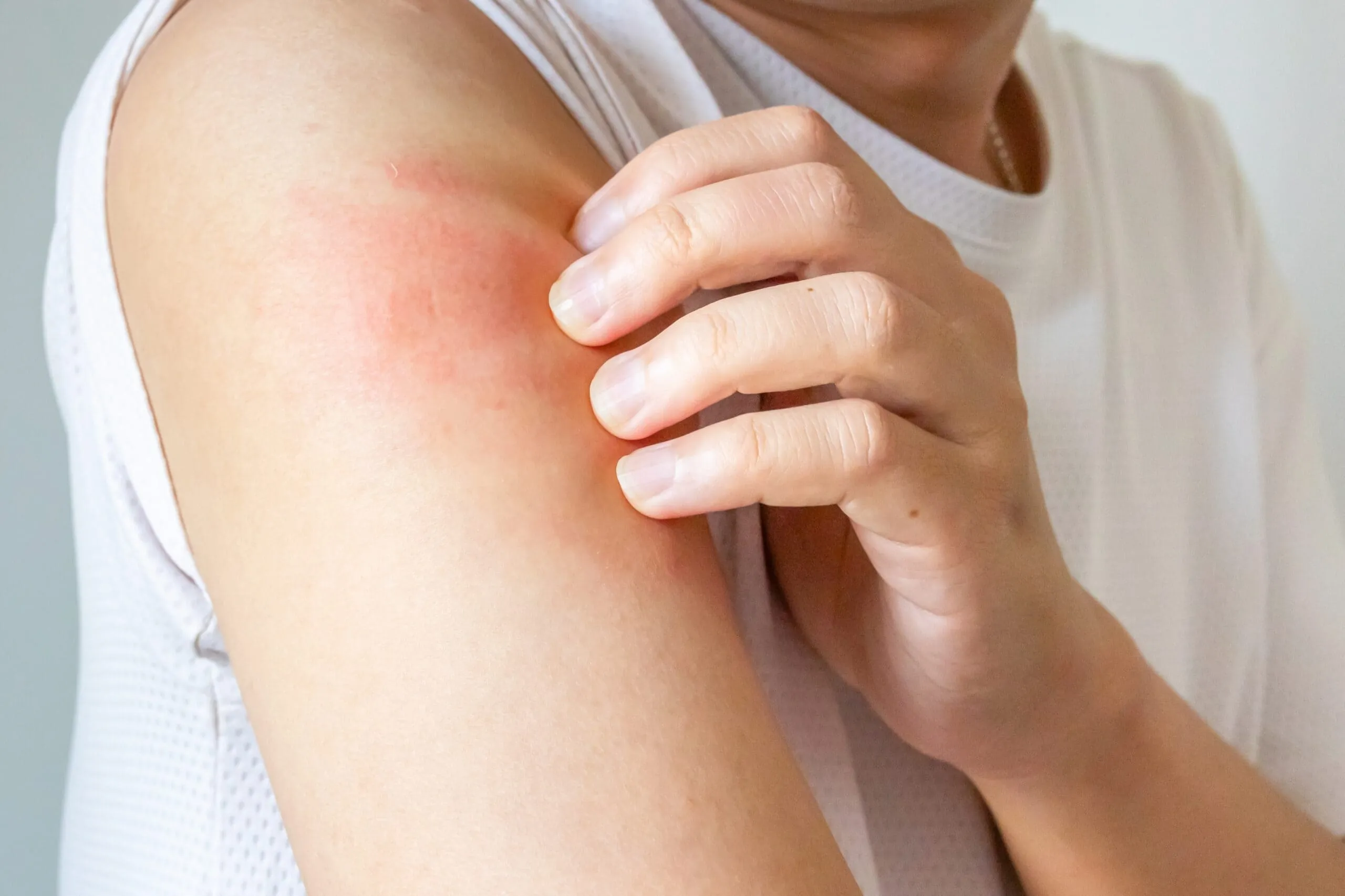 How to Recognize Common Skin Infections