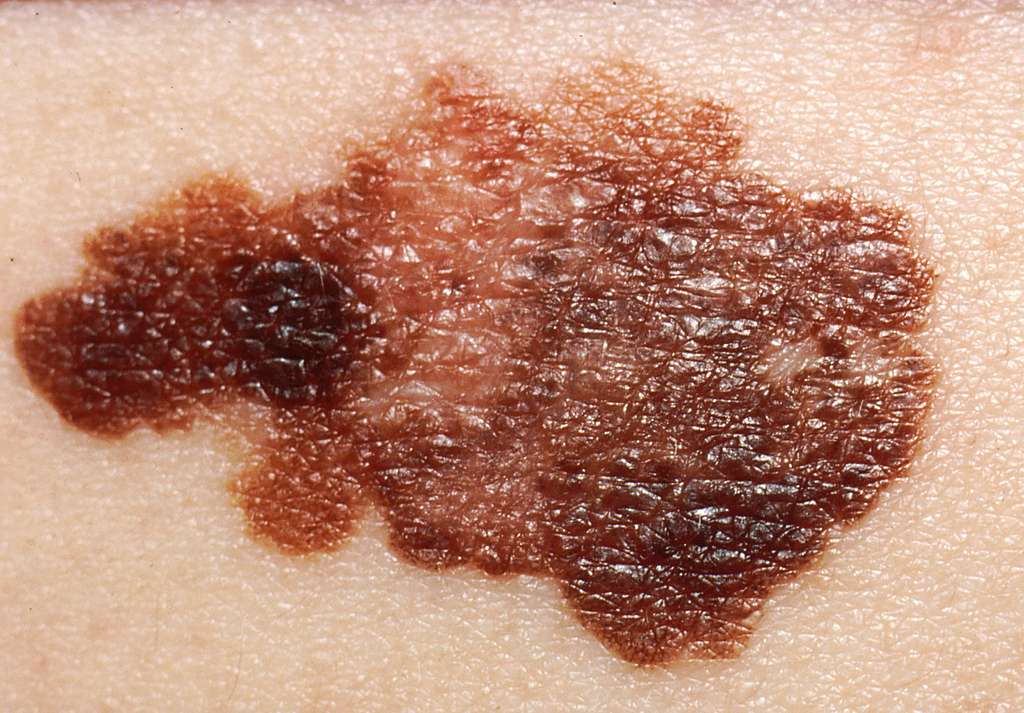 Recognizing the Symptoms of Melanoma
