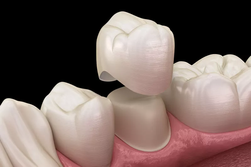 The Advantages of Different Materials Used in Dental Crowns
