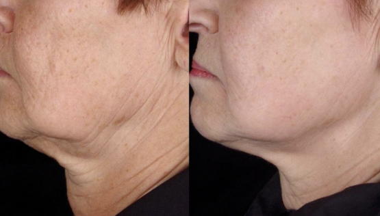 The Benefits of Opus Colibri for Skin Tightening