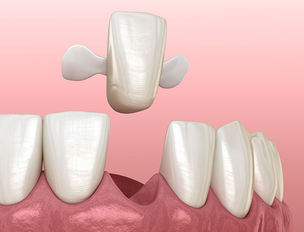 The Different Types of Crowns and Bridges: Which is Right for You?