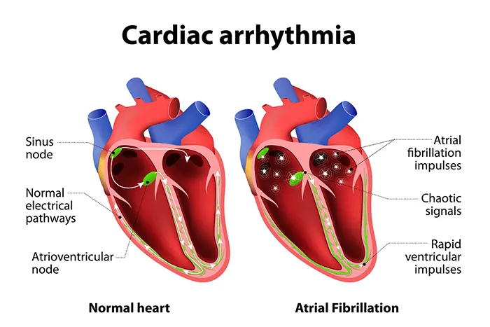 The Latest Advances In Atrial Fibrillation Treatment Options
