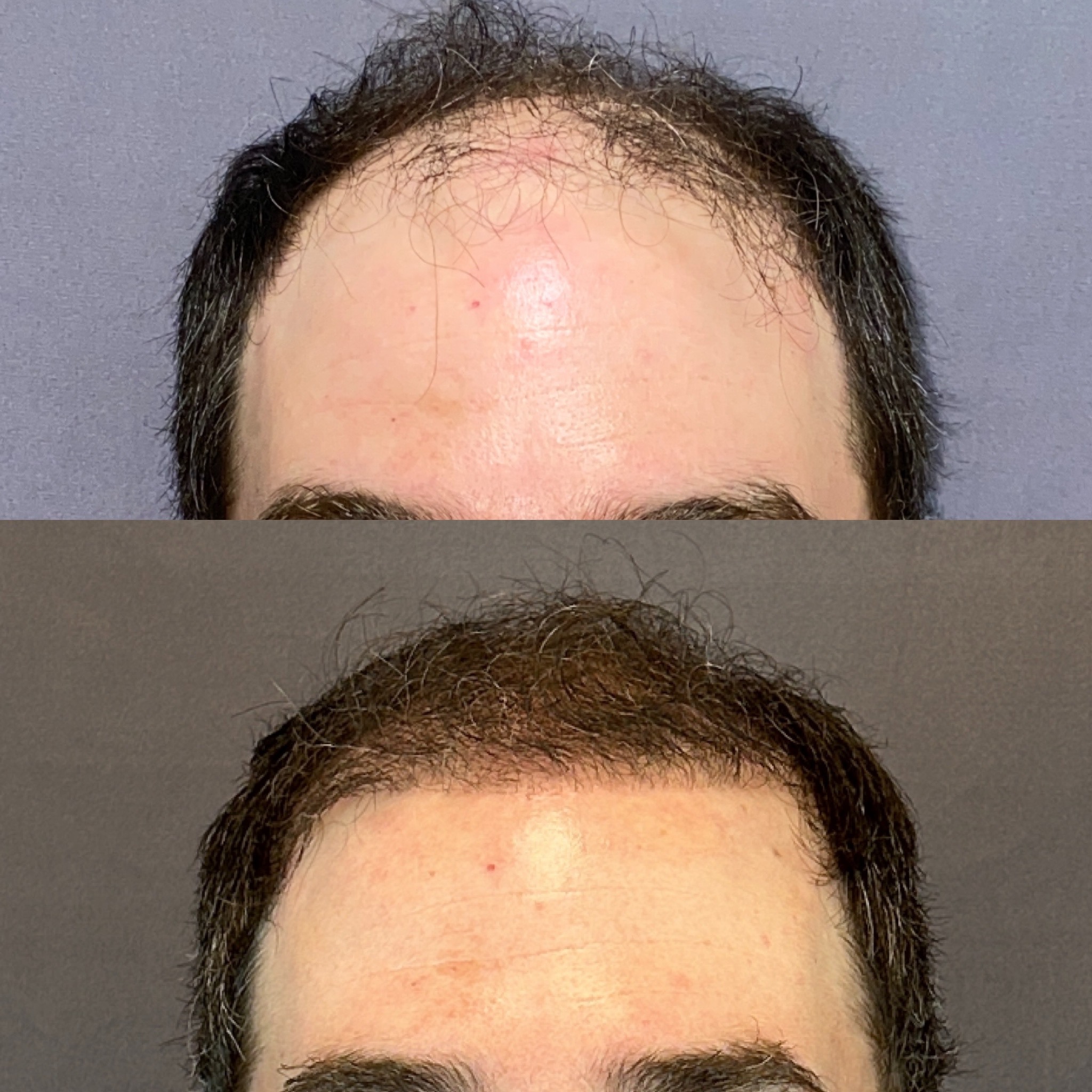 The Role of Hair Transplants in Restoring Youthful Appearance