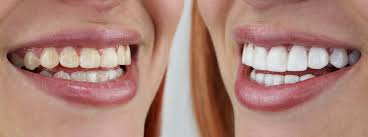 The Role of Professional Teeth Whitening in Smile Transformation