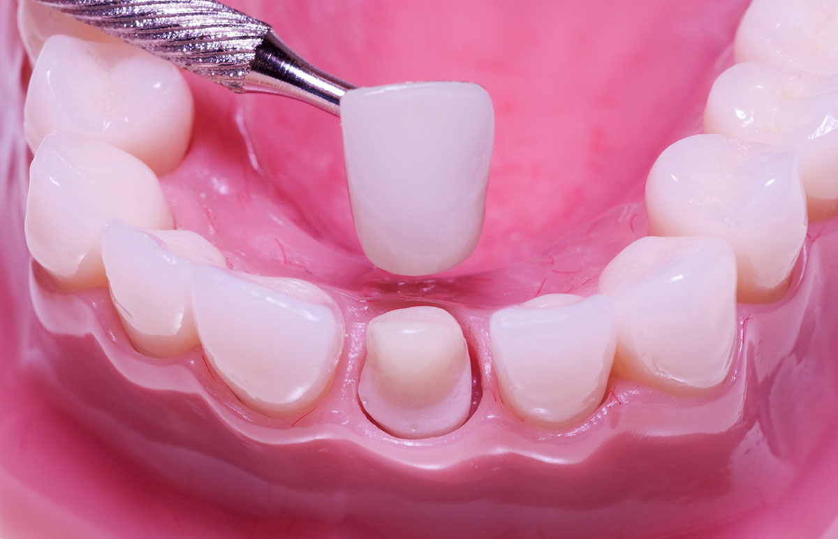 What Is a Dental Crown?