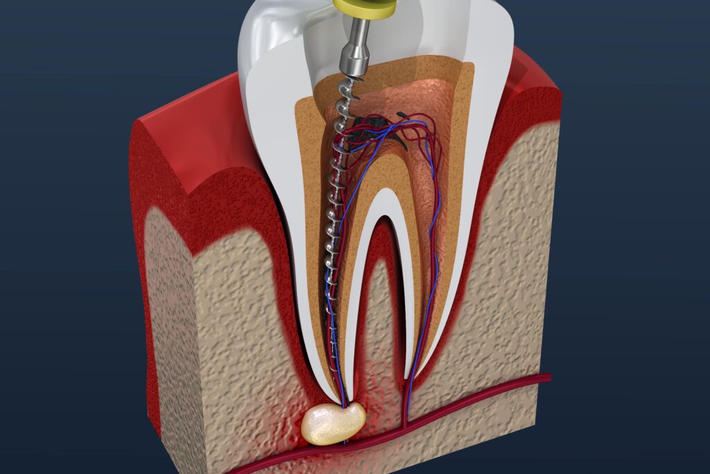 When Do You Need a Root Canal?